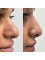 Non-Surgical Nose Job - Epping Beauty Clinic