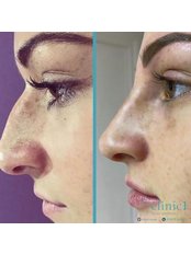 Non-Surgical Nose Job - The House Of Skin