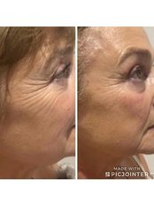 Radiofrequency Skin Tightening - The House Of Skin