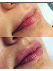 Lip Augmentation - The House Of Skin