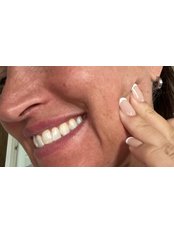 Bruxism - Teeth Grinding/Jaw Clenching Treatment - Kiss Kiss Aesthetics