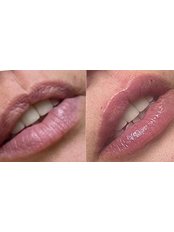 Lip Filler - Kiss Kiss Aesthetics