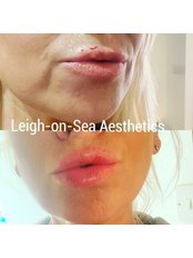 Lip Augmentation - Leigh-on-Sea Aesthetics