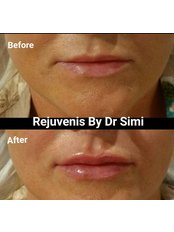 Lip Augmentation - Rejuvenis by Dr Simi