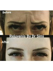 Treatment for Wrinkles - Rejuvenis by Dr Simi