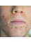 Vie Aesthetics Rayleigh - PlexR acne treatment (before) 