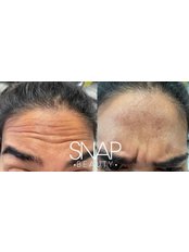Treatment for Wrinkles - Snap Beauty