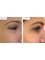 Cardiff Cosmetic Clinic - Crows Feet 