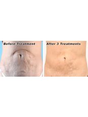 Stretch Marks - Cardiff Cosmetic Clinic