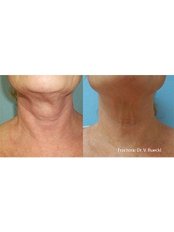 Fractora Radio Frequency - Cardiff Cosmetic Clinic