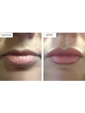 Lip Augmentation - Cardiff Cosmetic Clinic
