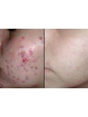 Acne Treatment - Cardiff Cosmetic Clinic