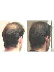 Hair Loss Treatment - Cardiff Cosmetic Clinic