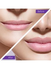 Lip Augmentation - Ageless Clinic Cardiff