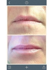 Lip augmentation (soft) - Rosmedics