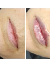 Lip Filler - Taste of Beauty  - Aesthetics & Permanent Makeup Clinic