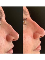 Non-Surgical Nose Job - Skinfinity