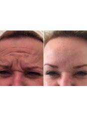 Treatment for Wrinkles - Skinfinity
