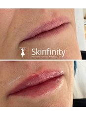 Lip Augmentation - Skinfinity