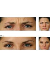 Treatment for Wrinkles - The Grove Skin & Laser Clinic