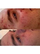 Skin Peel- The Perfect Peel - The Grove Skin & Laser Clinic