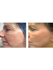 Fractional CO2 Laser Treatment - The Grove Skin & Laser Clinic