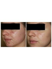 Acne Treatment - The Grove Skin & Laser Clinic