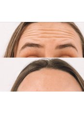Treatment for Wrinkles - Helen Cleland