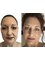 Ruth Jackson Aesthetics - microneedling facial 