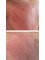 Ruth Jackson Aesthetics - micro needling with skin boosters 
