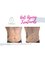 We Love Beauty Ltd - Anti aging treatment fat freezing on tummy 