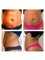 We Love Beauty Ltd - Body Sculpting with fat freezing and HIFU 
