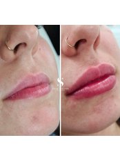 Lip Augmentation - Skin Sister