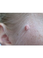 Mole Removal - Skin-hub