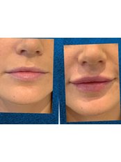 Lip Augmentation - Elysium Clinic
