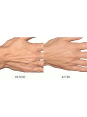 example of hand filler before and after - Simply Fox