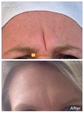 Treatment for Wrinkles- 1 Area - Simply Fox