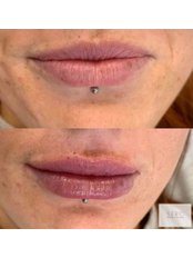 Lip Augmentation - Sero Aesthetics Ltd