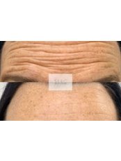 Treatment for Wrinkles - Sero Aesthetics Ltd