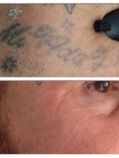 Laser Tattoo Removal Specialist at Kingston Ink tattoo studio in Portsmouth Hampshire  - Kingston Ink Laser Tattoo Removal