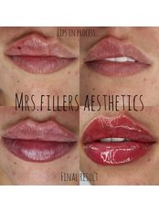 Lip Filler - Mr. & Mrs. Fillers Aesthetics
