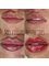 Mr. & Mrs. Fillers Aesthetics - lip filler Portsmouth 