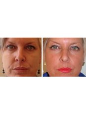 Non-Surgical Facelift - The Green Room - Ringwood Clinic