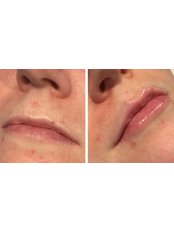Lip Augmentation (1.1ml) - Danielle Rose - Acaedmy of Excellence Ltd