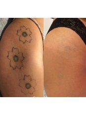 Tattoo Removal - Danielle Rose - Acaedmy of Excellence Ltd