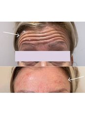 Treatment for Wrinkles - Firvale Clinic - Southampton