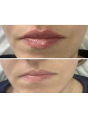 Lip Augmentation - Rachael Katie Cosmetics