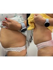Fat Reduction Injections - Rachael Katie Cosmetics