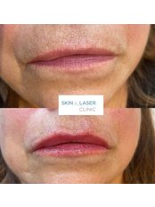 Lip Augmentation - Skin & Laser Clinic