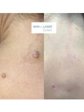 Skin Tag Removal - Skin & Laser Clinic